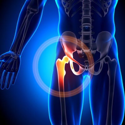 TSAGO Seeking Patients with Chronic Hip Pain for Hip Osteoarthritis Study