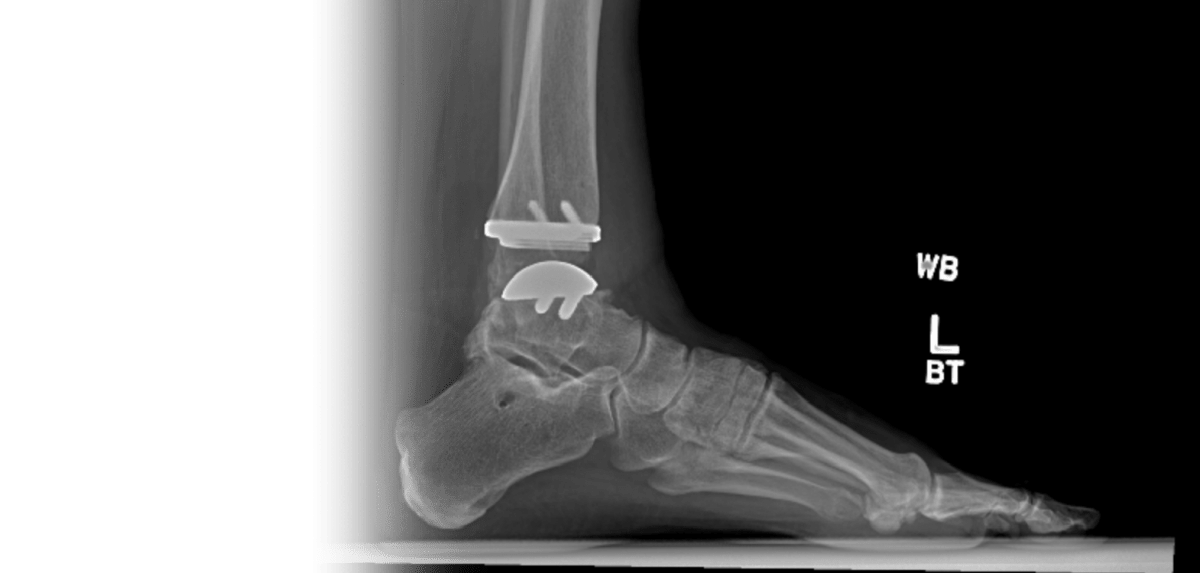 Ankle Replacement X-Ray