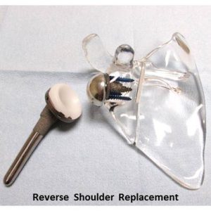 Reverse Shoulder Replacement Implant