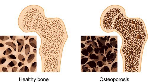 illustration of healthy bone versus osteoporosis bone