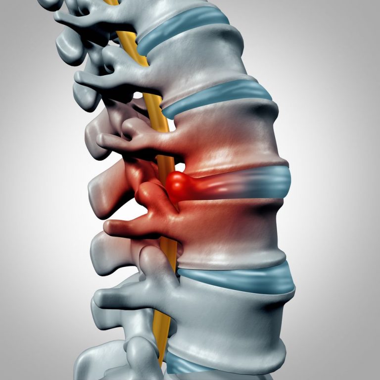 Back herniated disc