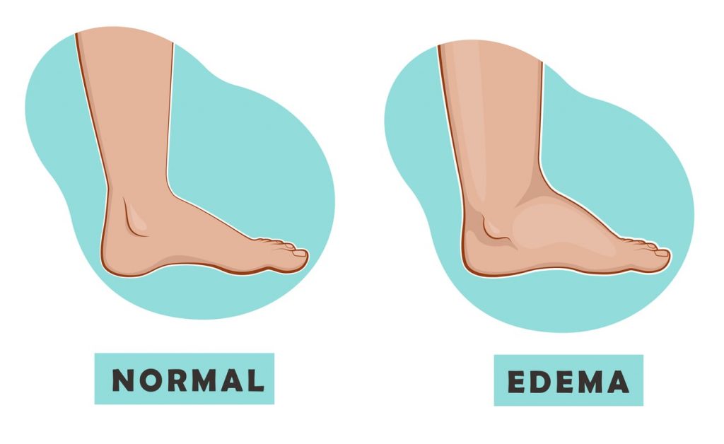 Foot, leg, and ankle swelling Information