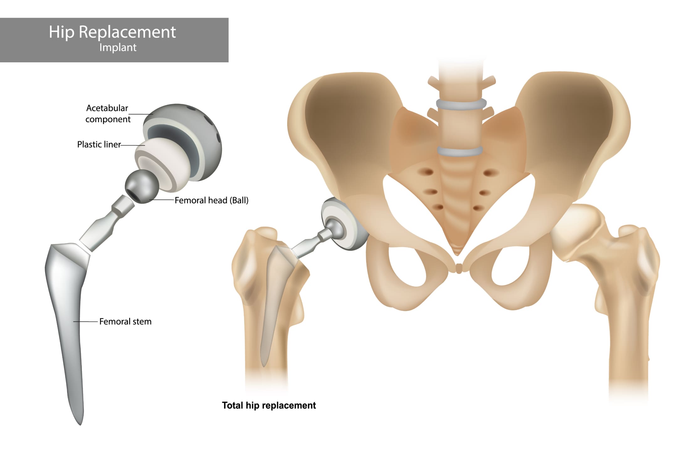 metal implant for hip replacement