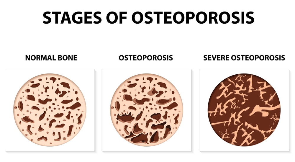 Comparison of Osteoporosis