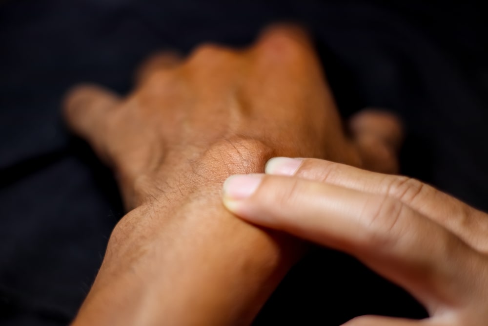 Hand with a Ganglion Cyst from working